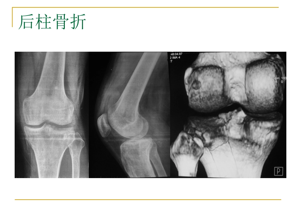胫骨平台骨折的分型与治疗_第12页