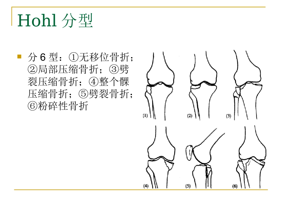 胫骨平台骨折的分型与治疗_第6页