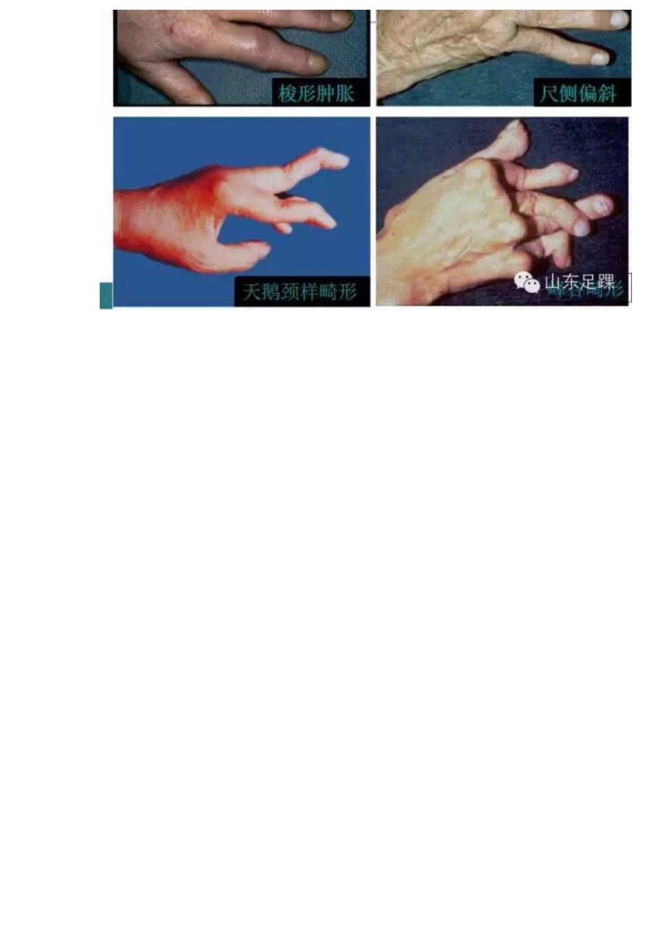 类风湿性关节炎的诊断及治疗策略_第11页