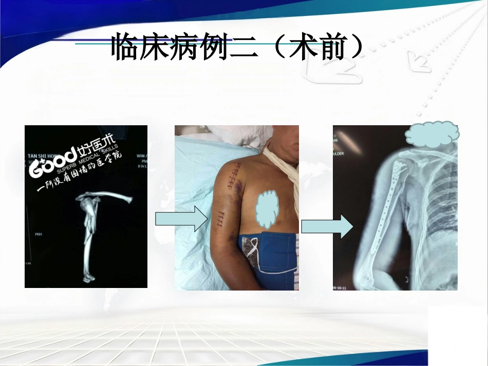 经皮微创锁定钢板治疗肱骨骨折(1)_第11页