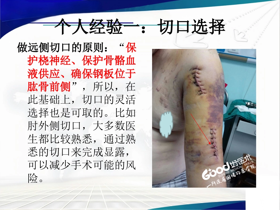 经皮微创锁定钢板治疗肱骨骨折(1)_第15页