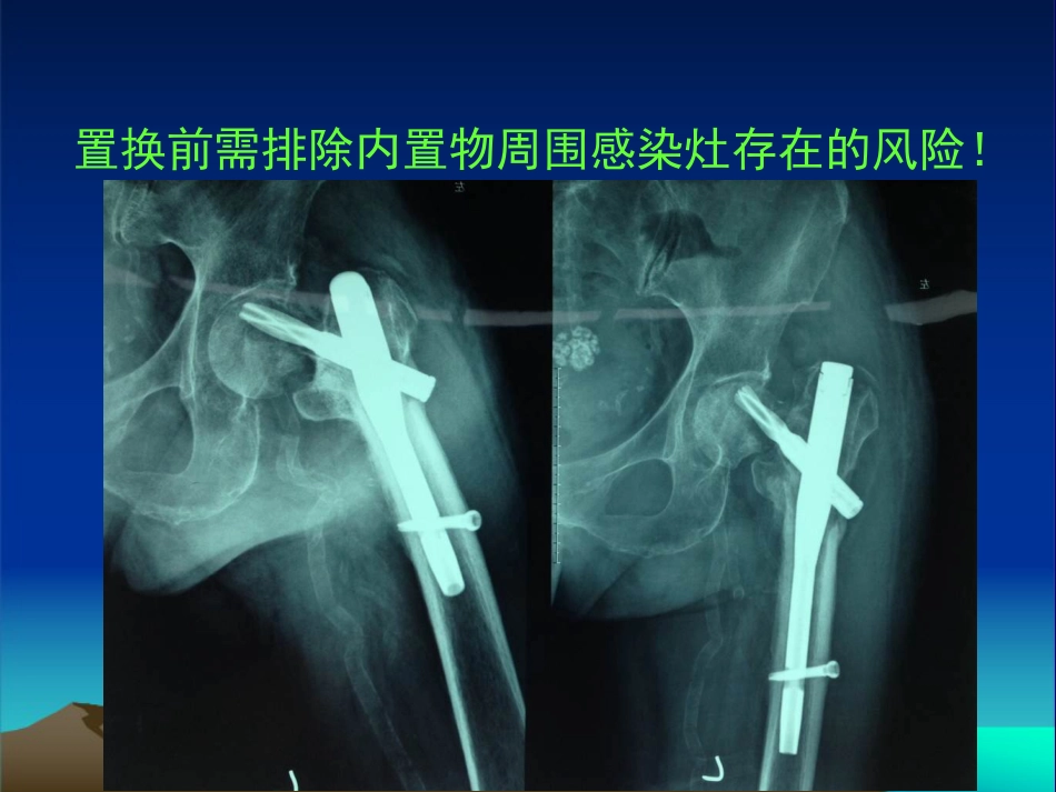 复杂性髋关节THA系列二 (1)_第10页