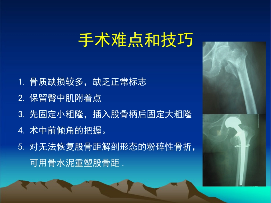 复杂性髋关节THA系列二 (1)_第8页