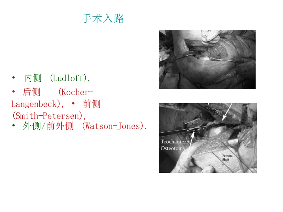 股骨头骨折--入路选择(1)_第7页