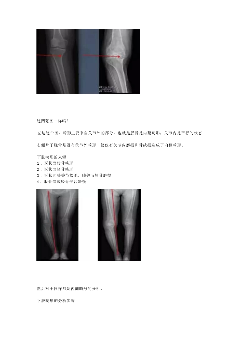 胫骨高位截骨术(1)_第10页