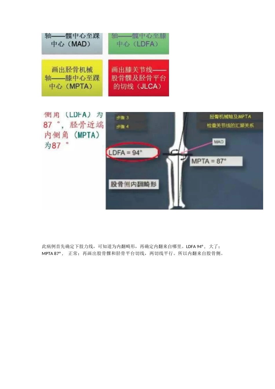 胫骨高位截骨术(1)_第11页