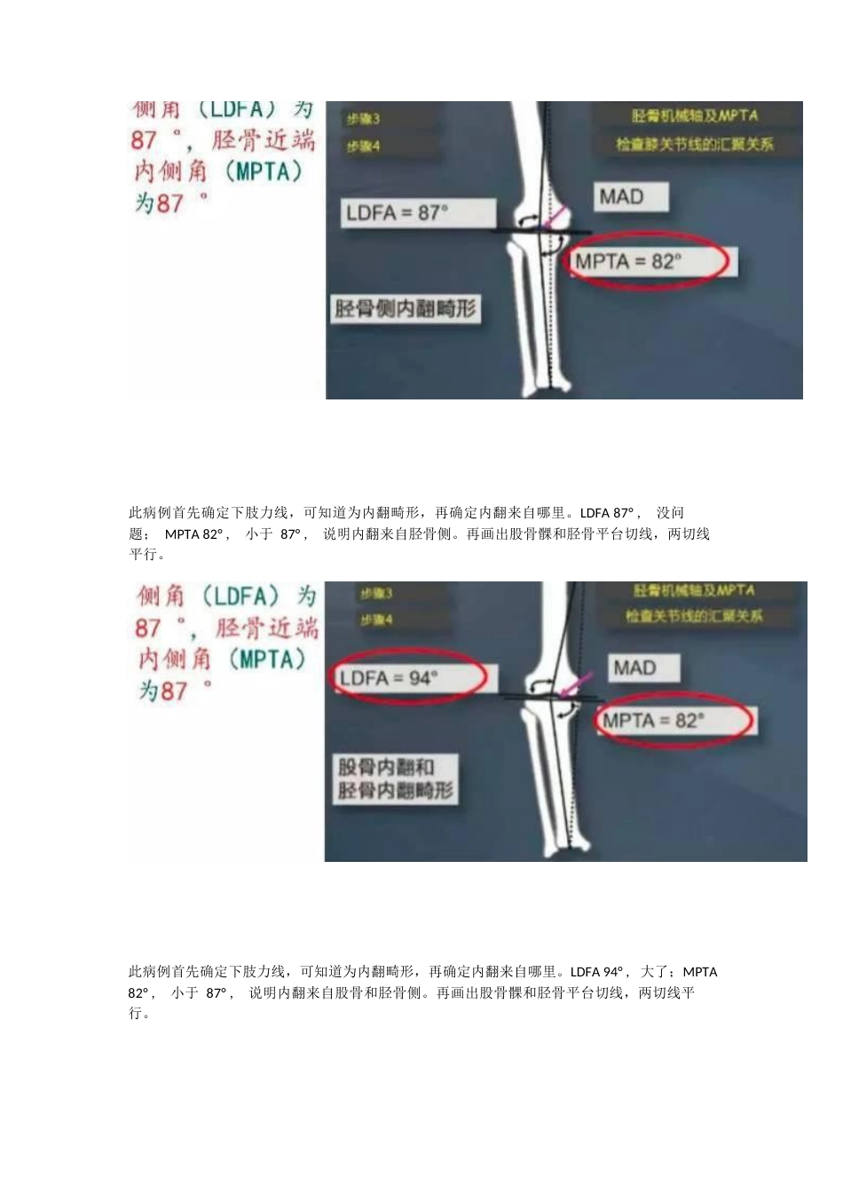 胫骨高位截骨术(1)_第12页