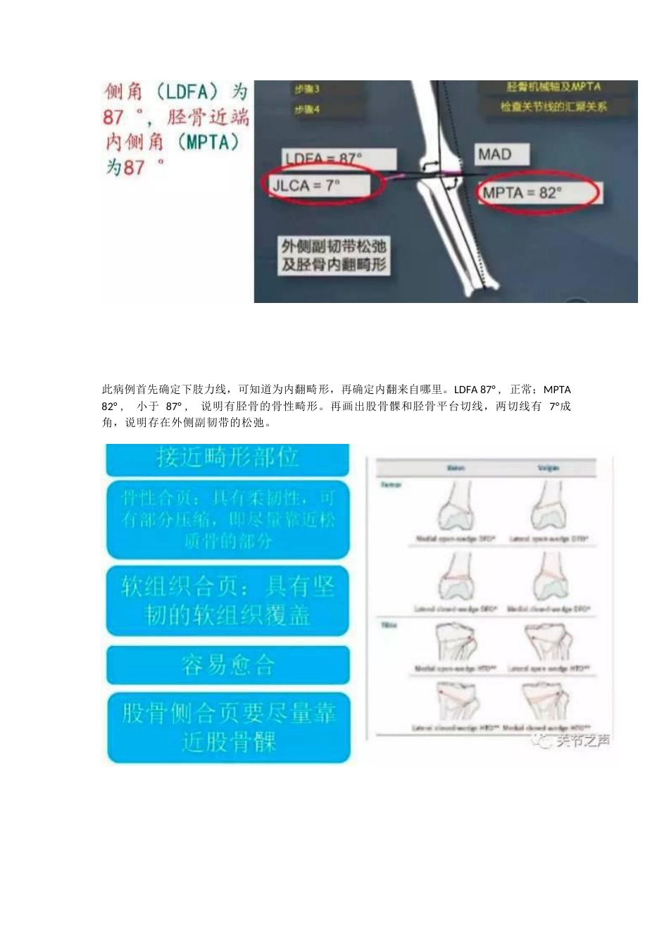 胫骨高位截骨术(1)_第13页