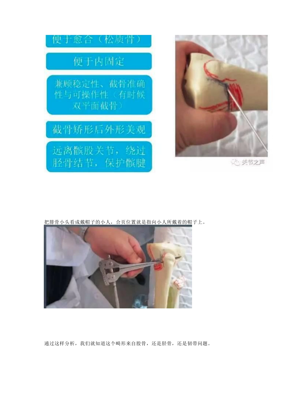 胫骨高位截骨术(1)_第14页