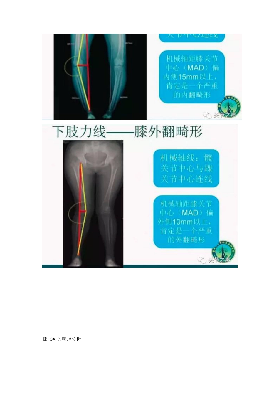 胫骨高位截骨术(1)_第9页