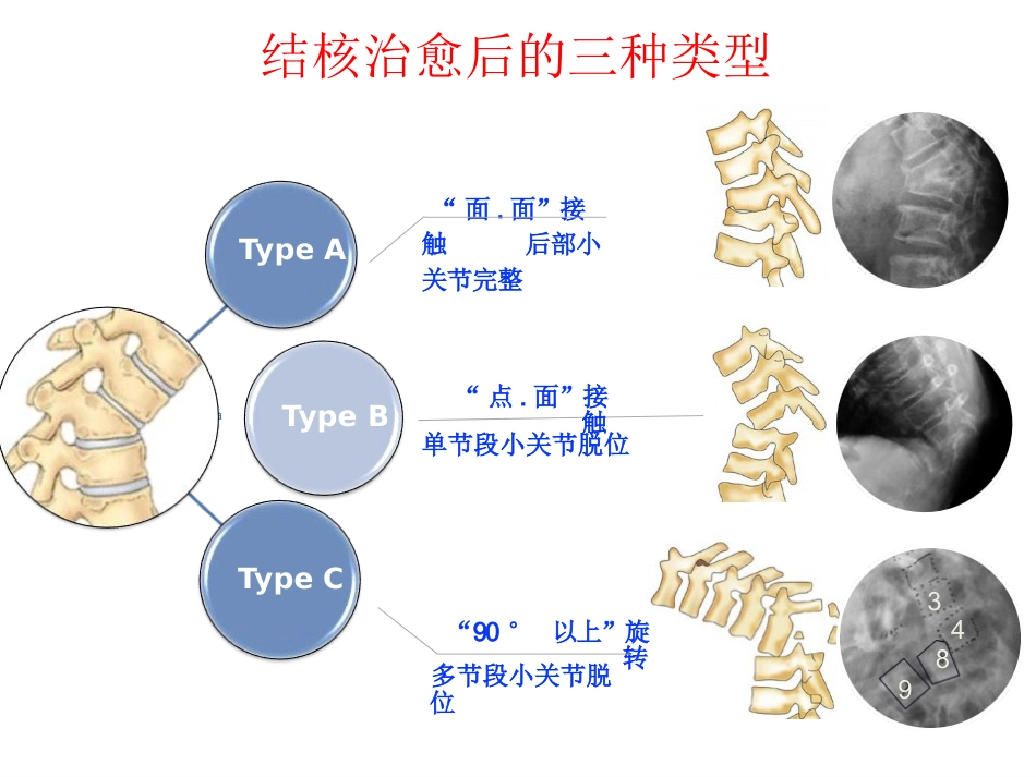 陈旧性结核后凸的手术治疗(1)_第14页