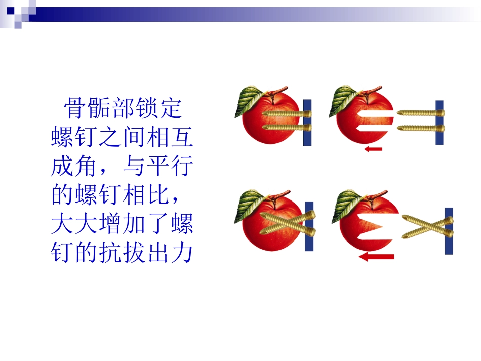 锁定钢板的应用及注意事项(1)_第11页