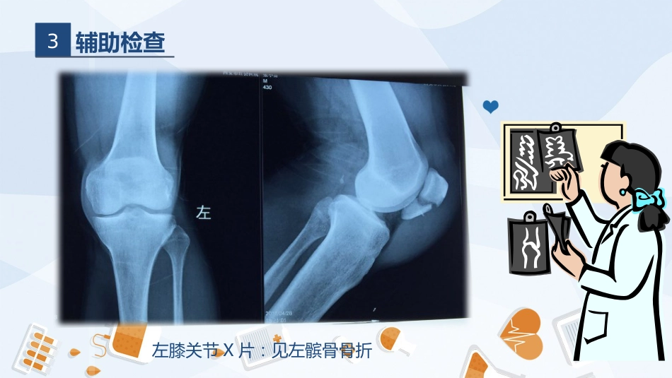 骨科-髌骨骨折的护理查房2_第14页