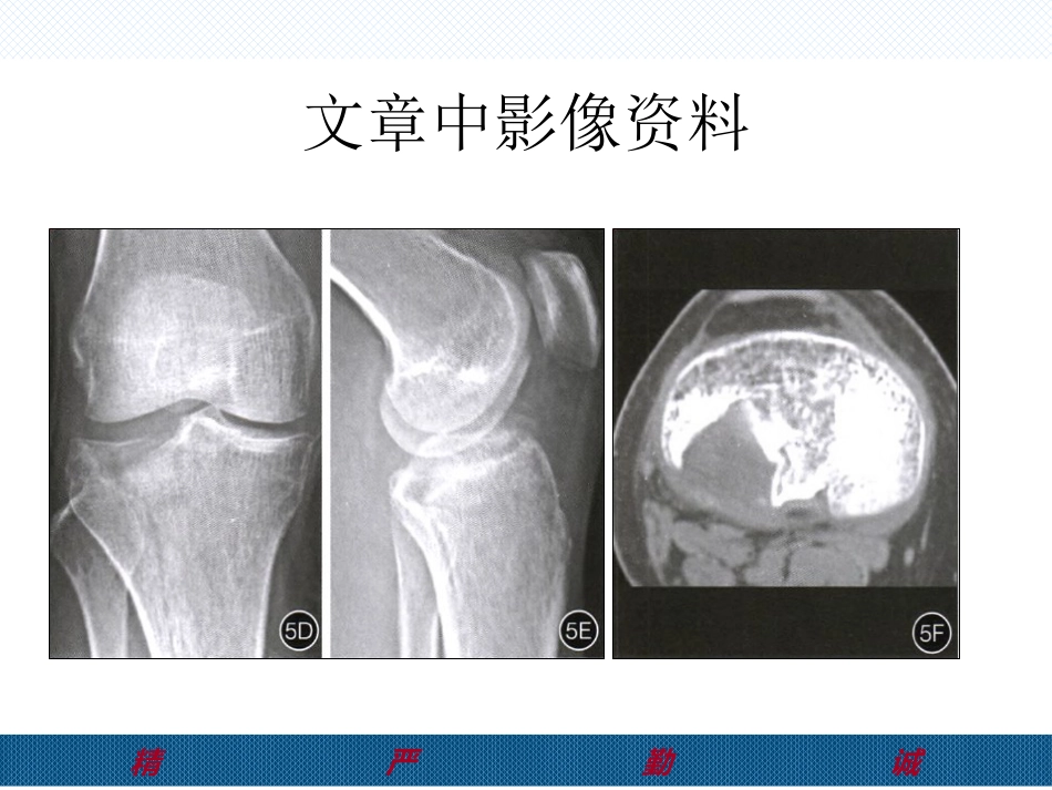 胫骨后外侧平台骨折处理-2(1)_第3页