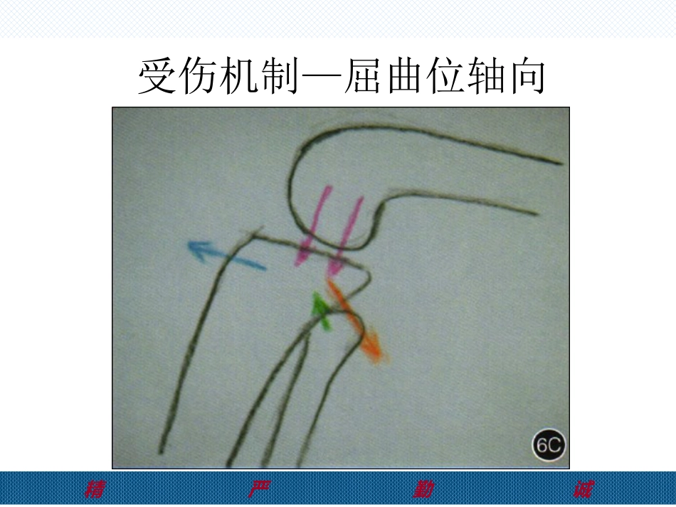 胫骨后外侧平台骨折处理-2(1)_第4页