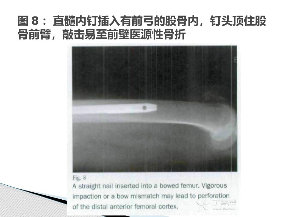 转子间骨折的10个手术技巧_第11页