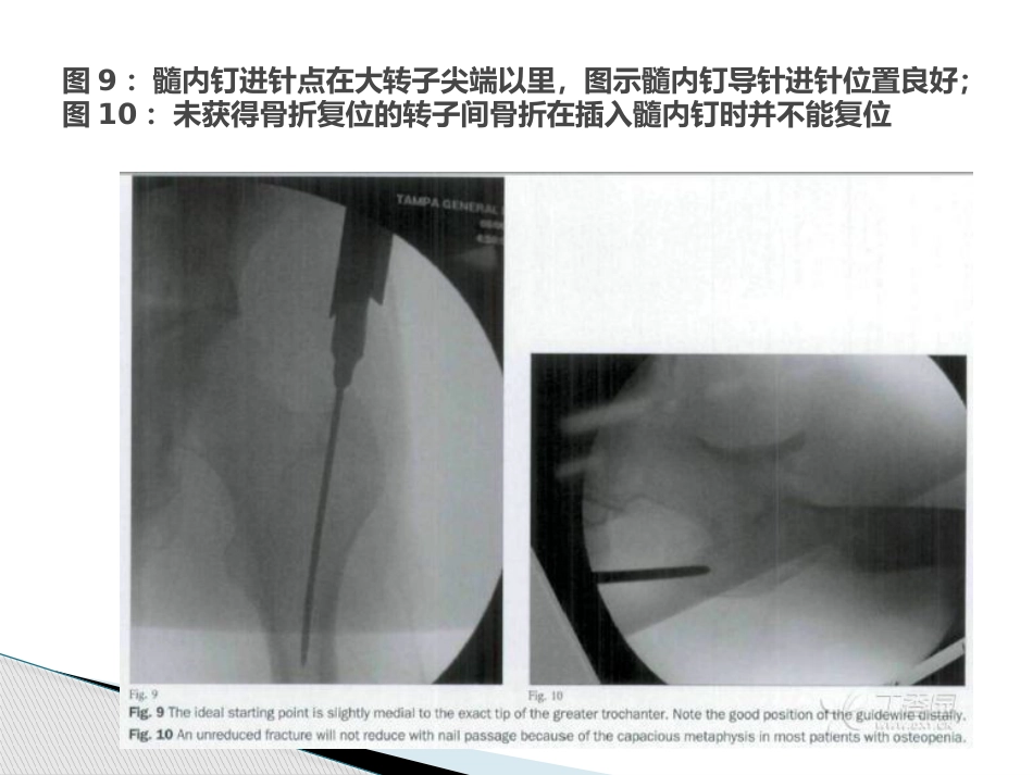 转子间骨折的10个手术技巧_第13页