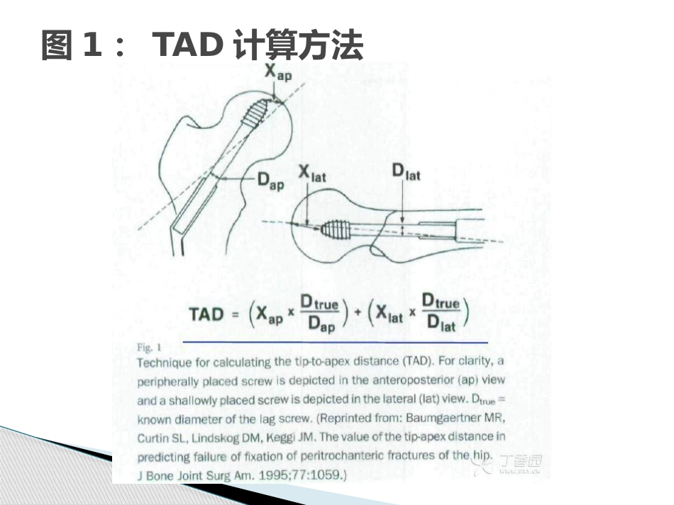 转子间骨折的10个手术技巧_第4页