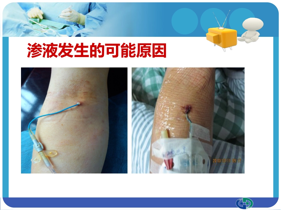 PICC穿刺点渗液与皮肤过敏的处理_第10页
