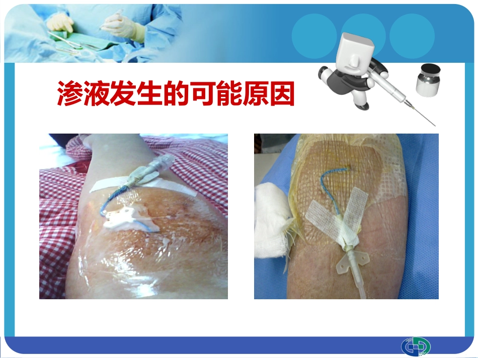 PICC穿刺点渗液与皮肤过敏的处理_第9页