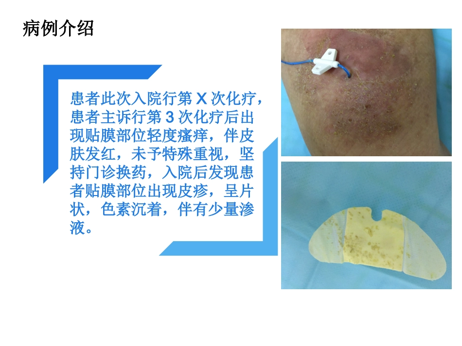 PICC过敏性皮炎个案汇报_第4页
