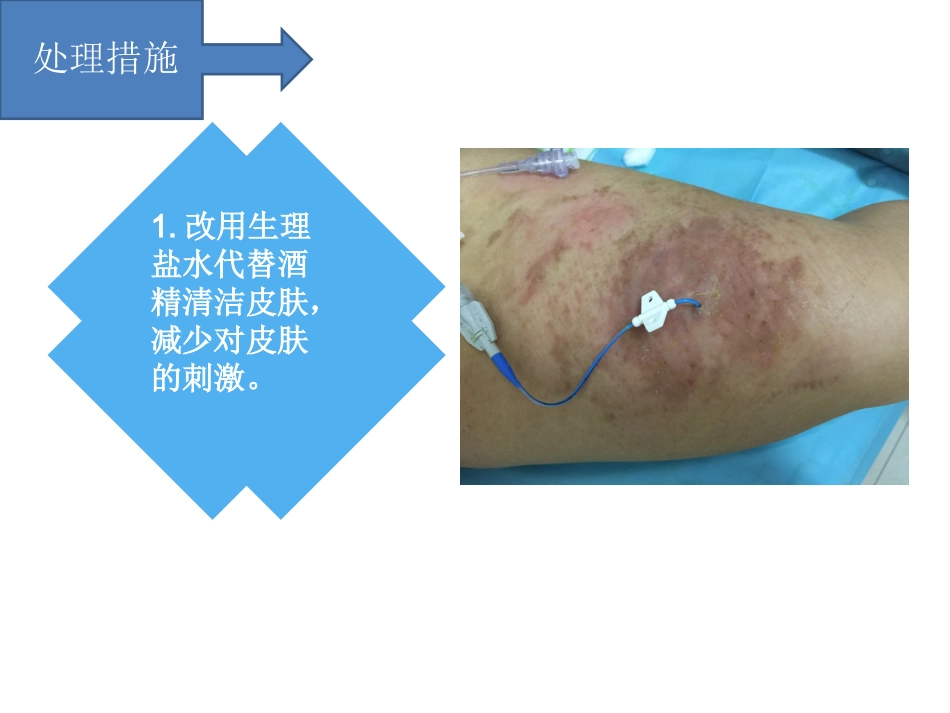 PICC过敏性皮炎个案汇报_第5页