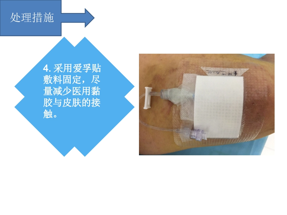 PICC过敏性皮炎个案汇报_第8页