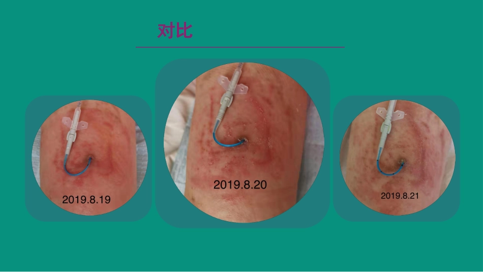 Picc导管皮肤相关性皮炎案例与分析_第11页