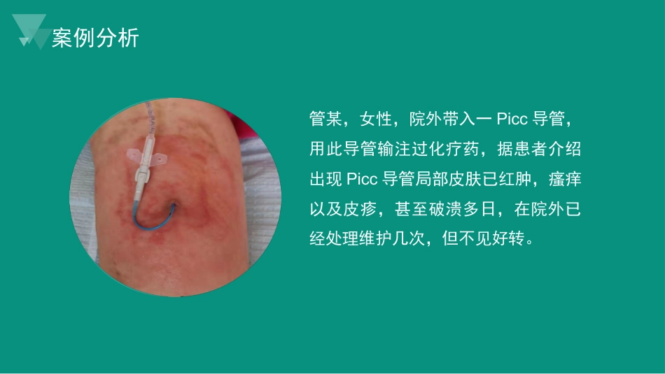 Picc导管皮肤相关性皮炎案例与分析_第6页
