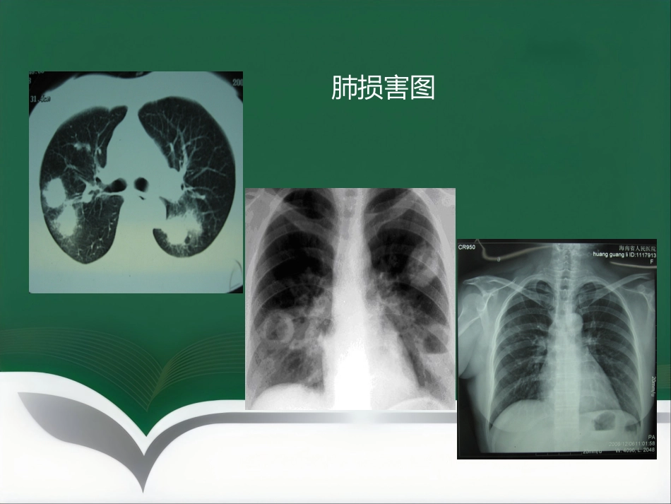 推荐ANCA相关性血管炎诊疗进展_第10页
