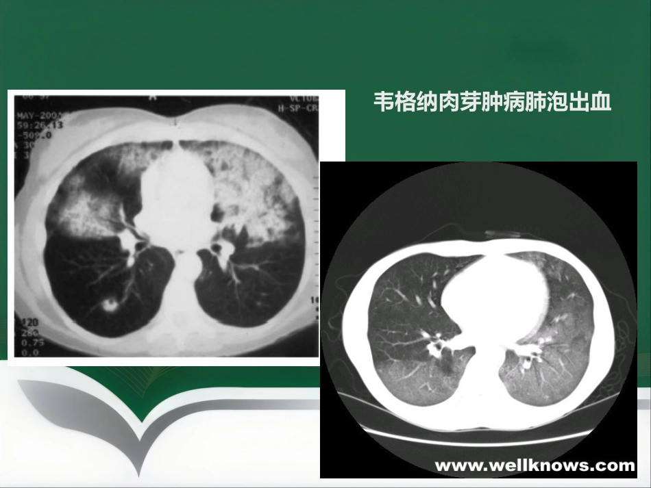 推荐ANCA相关性血管炎诊疗进展_第14页