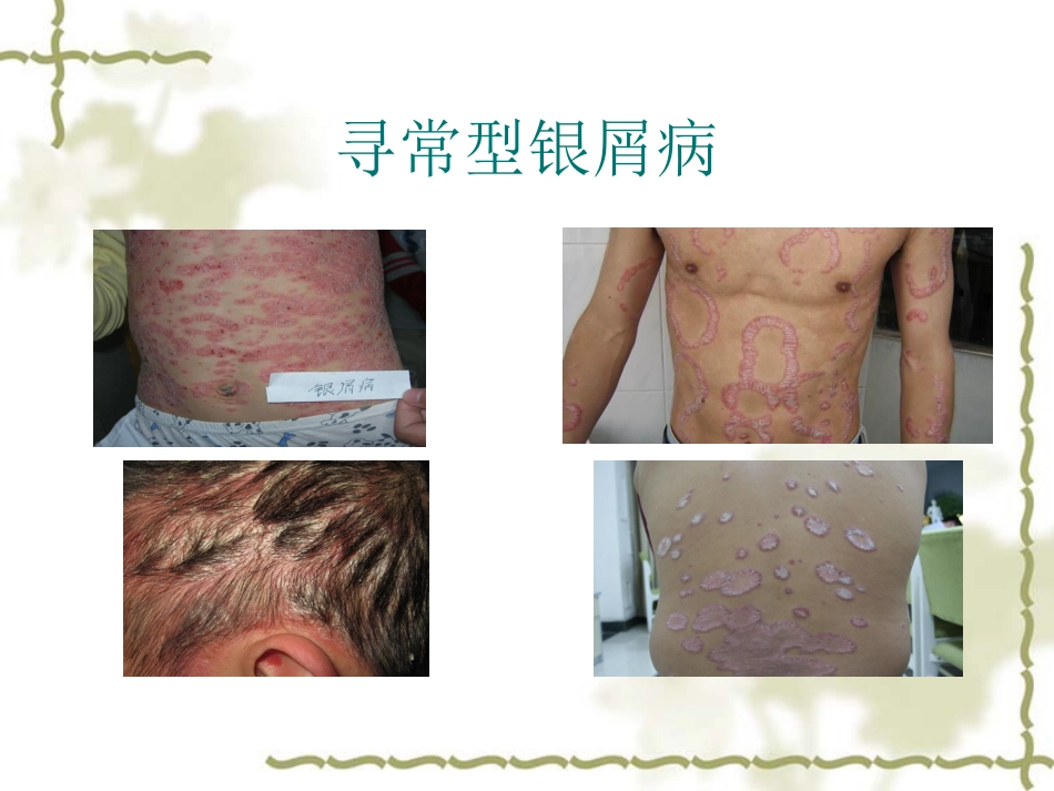 NB-UVB在治疗寻常型银屑病的应用_第2页