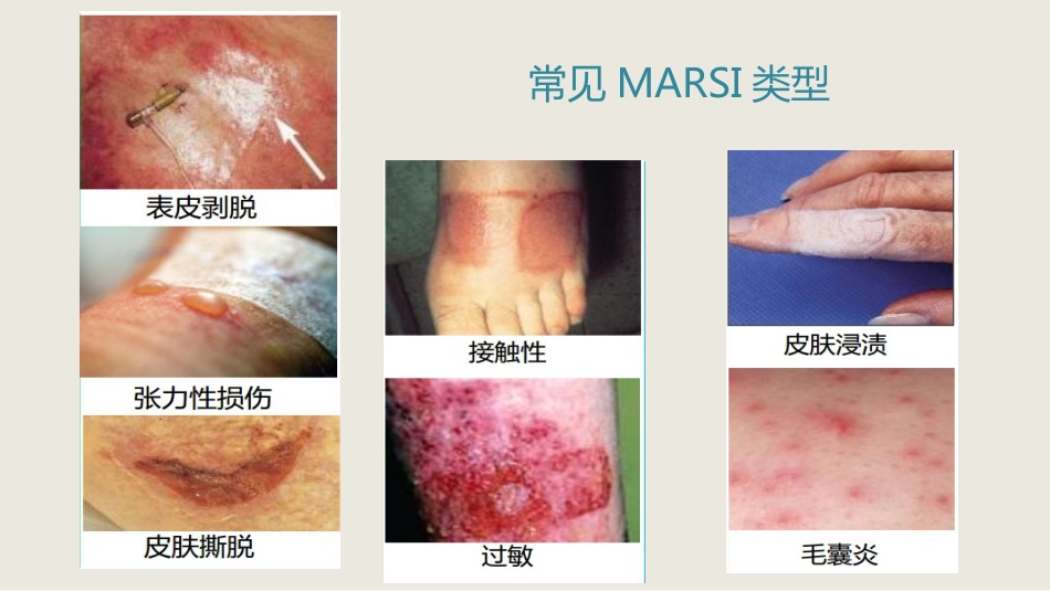 MARSI 医用黏胶相关皮肤损伤医学PPT课件_第14页