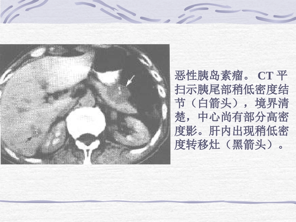 CT胰腺炎性病变_第7页