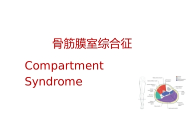 骨筋膜室综合征的诊治进展(1)