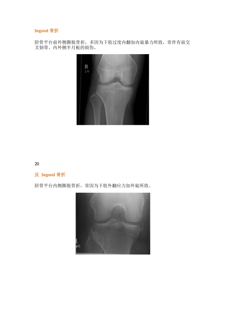 38种特殊类型的骨折_第11页