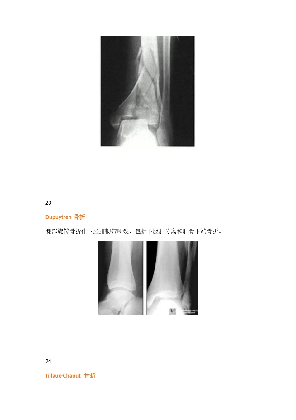 38种特殊类型的骨折_第13页