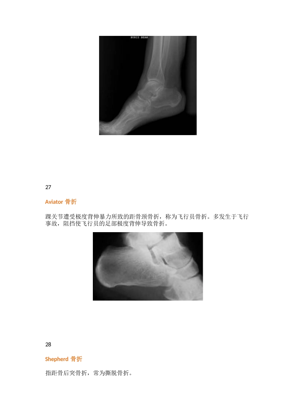 38种特殊类型的骨折_第15页