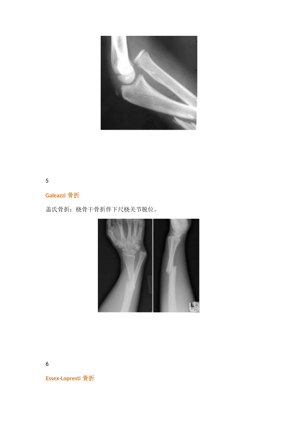 38种特殊类型的骨折_第3页