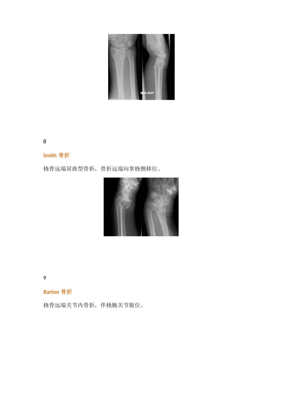 38种特殊类型的骨折_第5页
