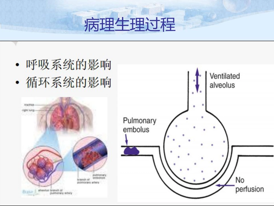肺栓塞的诊治及护理_第10页