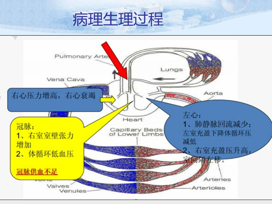肺栓塞的诊治及护理_第12页