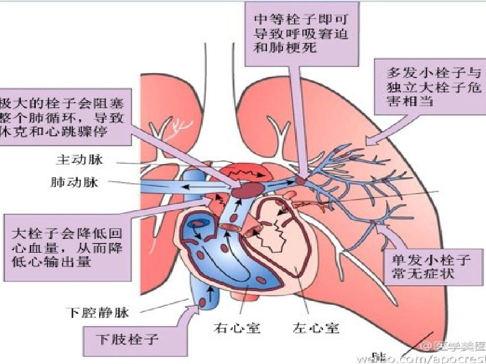肺栓塞病人的护理5_第15页