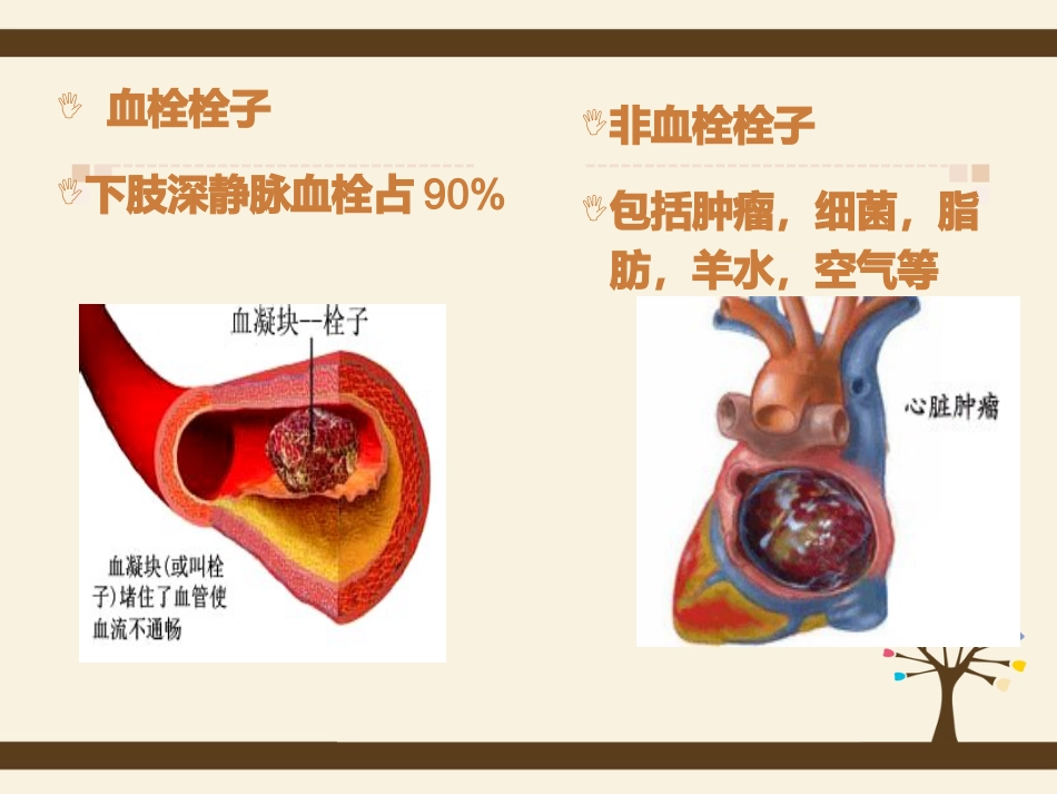 肺栓塞病人的护理5_第5页