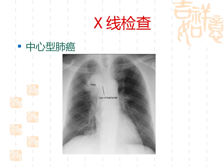 肺癌护理疑难病例讨论_第13页