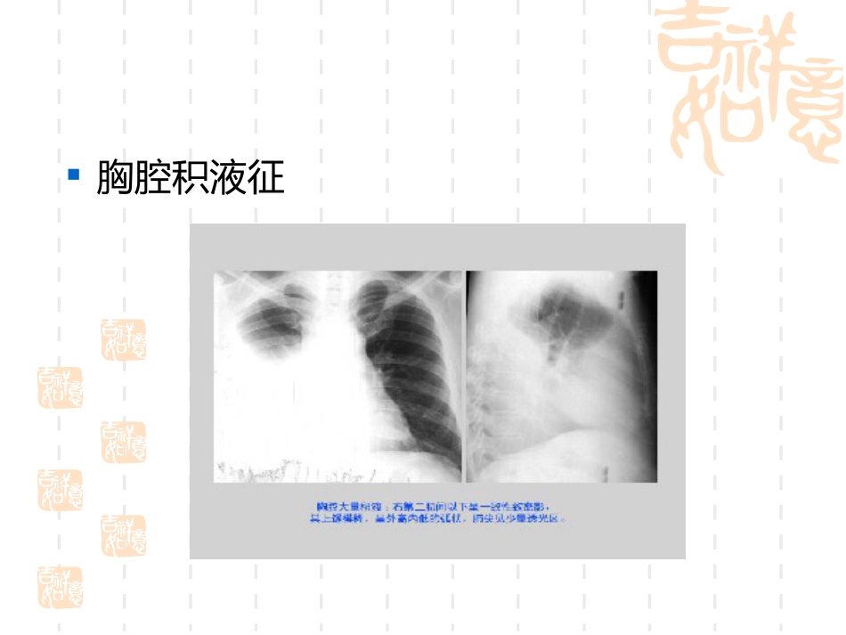 肺癌护理疑难病例讨论_第14页