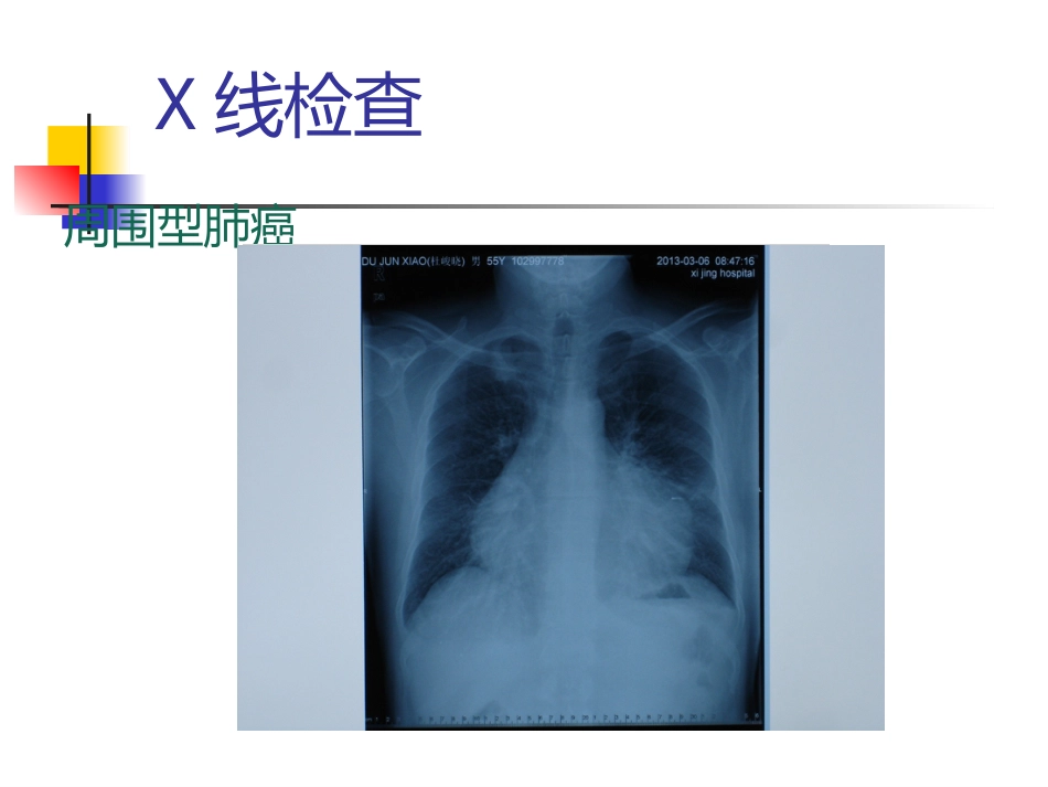 肺癌护理疑难病例讨论_第15页