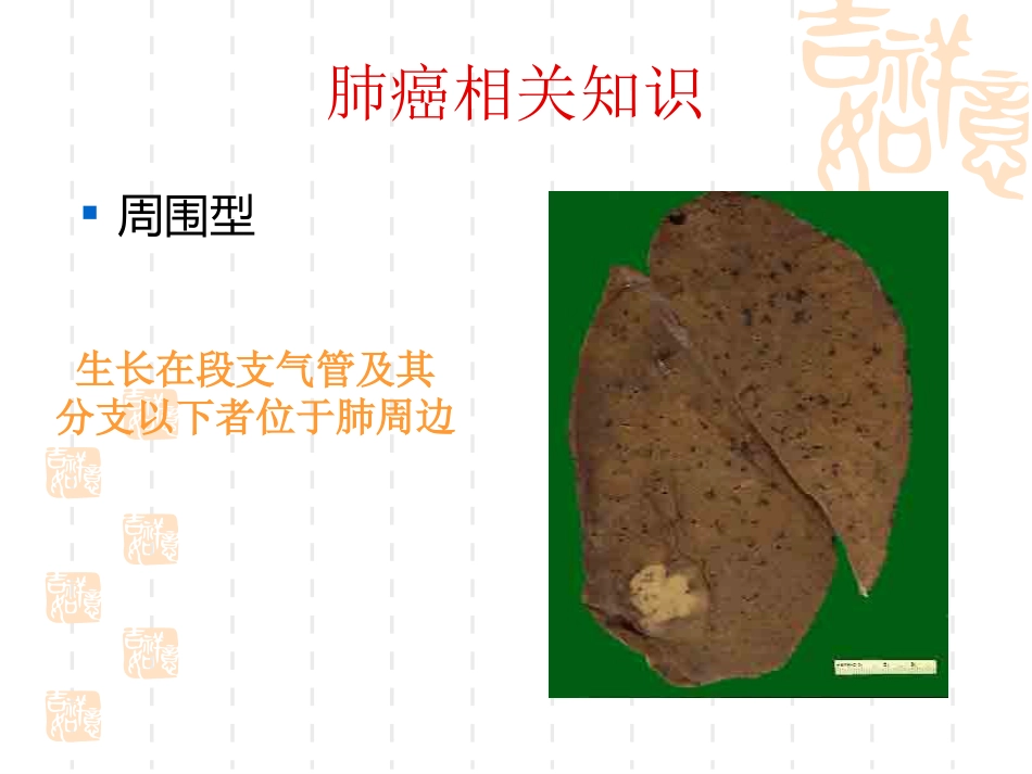 肺癌护理疑难病例讨论_第9页
