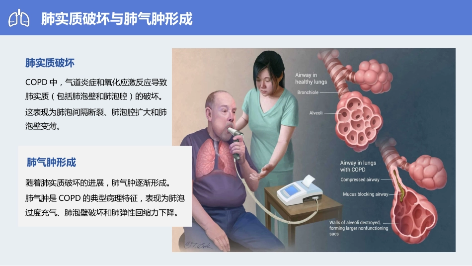 经鼻高流量湿化氧疗在COPD患者中的应用_第12页