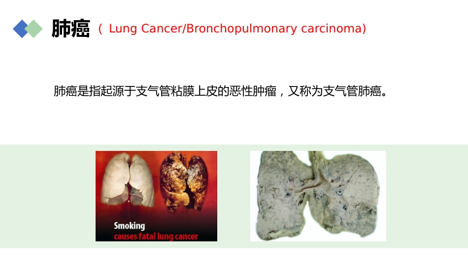 肺癌的早期诊断与防治_第5页